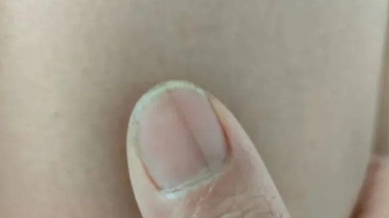 最新指甲黑线研究：专家警告不要忽视指甲颜色的变化